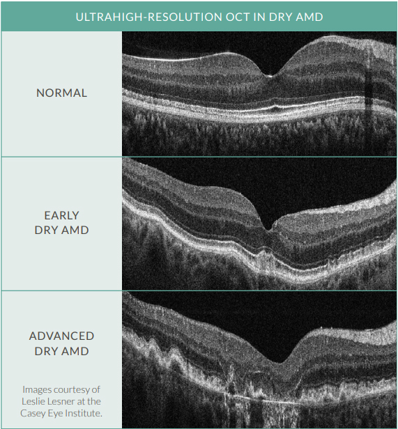 Three black and white ultrahigh-resolution OCT images of normal eye tissue, early dry AMD and advanced dry AMD