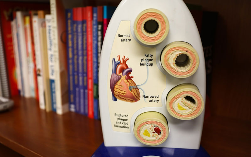 model of arteries and plaque buildup